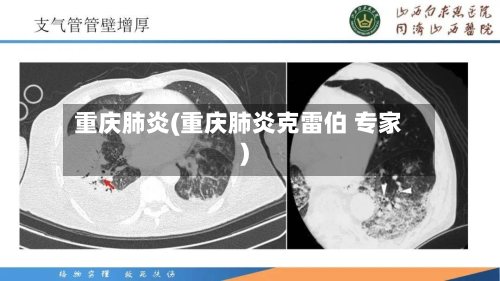 重庆肺炎(重庆肺炎克雷伯 专家)-第2张图片